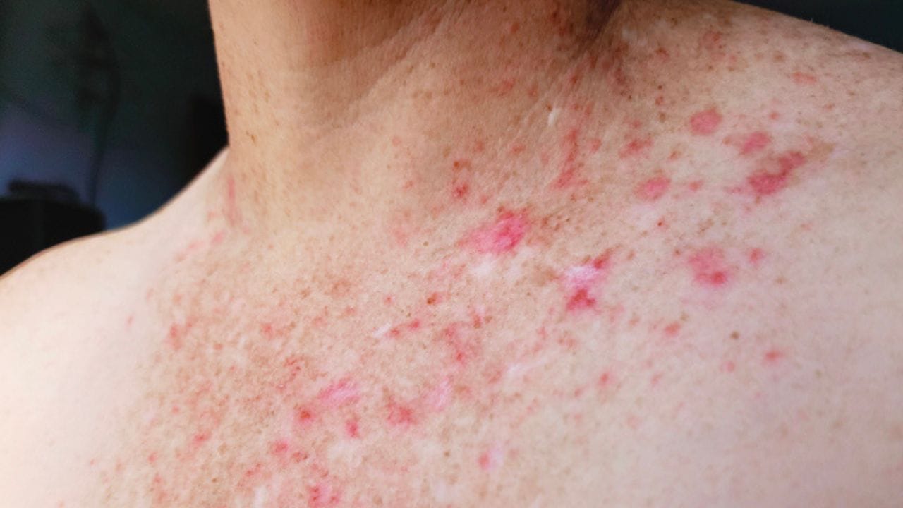 ದೇಹದಲ್ಲಿ ಪದೇಪದೇ ದದ್ದುಗಳು ಕಂಡುಬರುತ್ತಿದ್ದರೆ ನಿರ್ಲಕ್ಷಿಸಬೇಡಿ! ಇದು ಈ ರೋಗ ಬರುವ ಮುನ್ಸೂಚನೆ