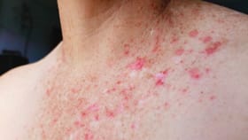 ದೇಹದಲ್ಲಿ ಪದೇ ಪದೇ ದದ್ದುಗಳು ಕಾಣಿಸಿಕೊಳ್ಳುವುದಕ್ಕೆ ಕಾರಣವೇನು ಗೊತ್ತಾ?