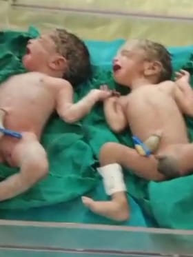 ಎರಡನೇ ಹೆರಿಗೆಯಲ್ಲಿ ತ್ರಿವಳಿ ಮಕ್ಕಳಿಗೆ ಜನ್ಮ ನೀಡಿದ ಬಸಮ್ಮ