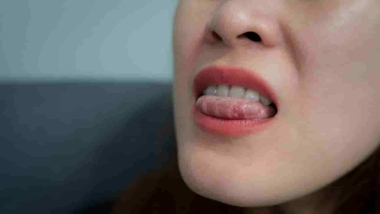 ನಾಲಿಗೆಯಲ್ಲಿ ಹುಣ್ಣುಗಳಾಗುವುದಕ್ಕೆ ಕಾರಣ ಏನ್ ಗೊತ್ತಾ? ಇದು ಗಂಭೀರ ರೋಗದ ಮುನ್ಸೂಚನೆಯೇ? ಇಲ್ಲಿದೆ ಉತ್ತರ