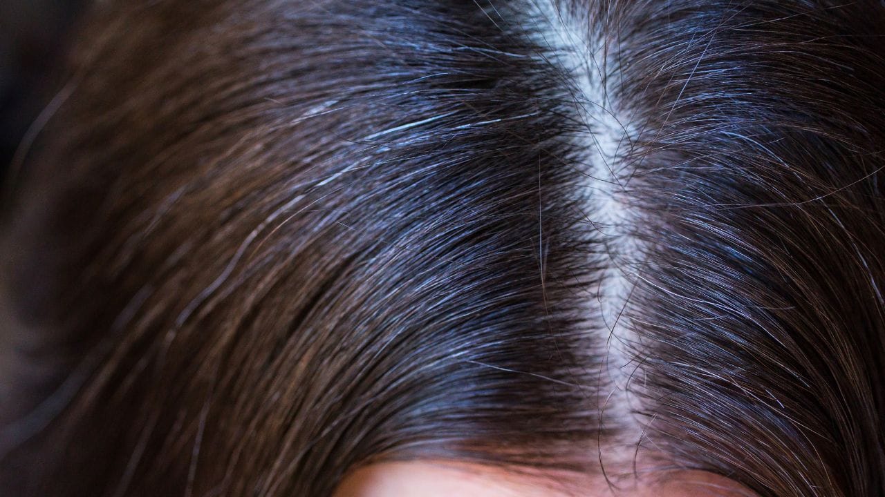 ಚಿಕ್ಕ ಮಕ್ಕಳಲ್ಲಿ ಕೂದಲು ಬಿಳಿಯಾಗುವುದಕ್ಕೆ ಕಾರಣವೇನು? ಕೊರತೆಯೇ ಅಥವಾ ರೋಗದ ಲಕ್ಷಣವೇ?