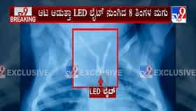 ಮಡಿಕೇರಿ: ಎಂಟು ತಿಂಗಳ ಮಗುವಿನ ಗಂಟಲಲ್ಲಿತ್ತು ಎಲ್​ಇಡಿ ಬಲ್ಬ್!