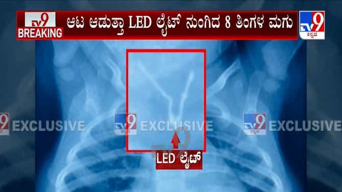 ಮಡಿಕೇರಿ: ಎಂಟು ತಿಂಗಳ ಮಗುವಿನ ಗಂಟಲಲ್ಲಿತ್ತು ಎಲ್​ಇಡಿ ಬಲ್ಬ್!