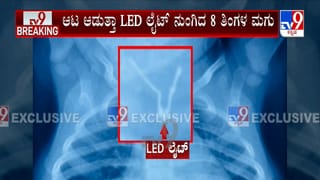 ಮಡಿಕೇರಿ: ಎಂಟು ತಿಂಗಳ ಮಗುವಿನ ಗಂಟಲಲ್ಲಿತ್ತು ಎಲ್​ಇಡಿ ಬಲ್ಬ್!
