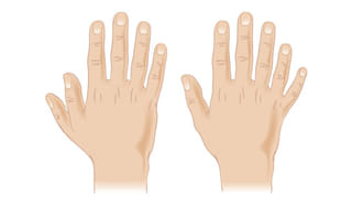 Palmistry: ಕೈಯಲ್ಲಿ ಆರು ಬೆರಳುಗಳಿದ್ದರೆ ಅದೃಷ್ಟವೇ? ಹಸ್ತಸಾಮುದ್ರಿಕ ಶಾಸ್ತ್ರ ಹೇಳುವುದೇನು?