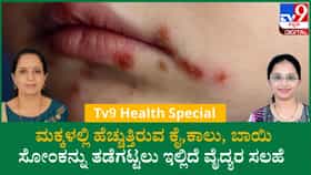 ಕೈ, ಕಾಲು, ಬಾಯಿ ಸೋಂಕನ್ನು ತಡೆಗಟ್ಟಲು ಇಲ್ಲಿದೆ ವೈದ್ಯರ ಸಲಹೆ