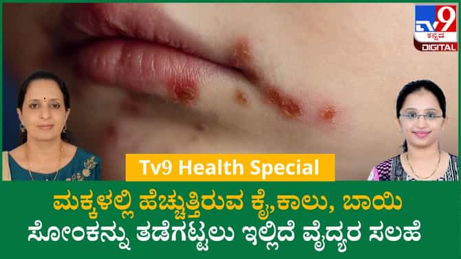 ಕೈ, ಕಾಲು, ಬಾಯಿ ಸೋಂಕನ್ನು ತಡೆಗಟ್ಟಲು ಇಲ್ಲಿದೆ ವೈದ್ಯರ ಸಲಹೆ