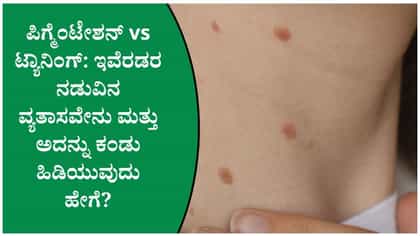 ಟ್ಯಾನಿಂಗ್ ಮತ್ತು ಪಿಗ್ಮೆಂಟೇಶನ್ ನಡುವಿನ ವ್ಯತ್ಯಾಸವೇನು?
