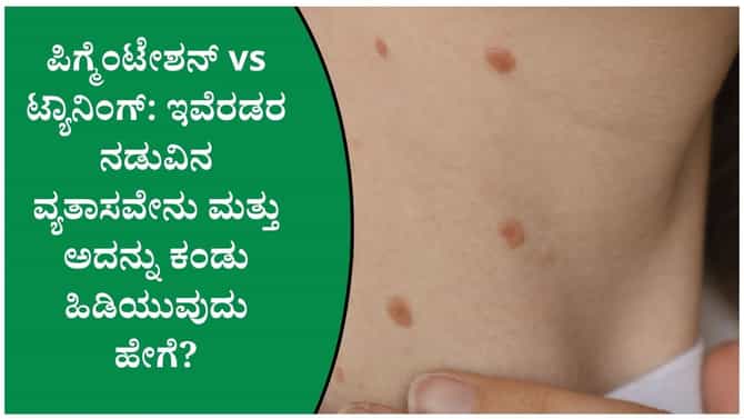 ಟ್ಯಾನಿಂಗ್ ಮತ್ತು ಪಿಗ್ಮೆಂಟೇಶನ್ ನಡುವಿನ ವ್ಯತ್ಯಾಸವೇನು?