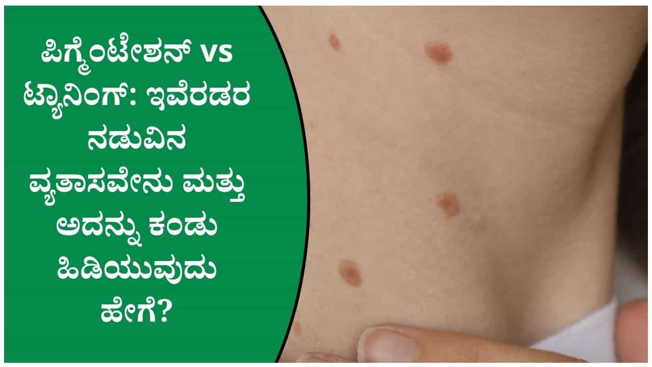 ಟ್ಯಾನಿಂಗ್ ಅಥವಾ ಪಿಗ್ಮೆಂಟೇಶನ್? ಮುಖ ಕಪ್ಪಾಗಲು ನಿಜವಾದ ಕಾರಣವೇನು? ಡರ್ಮಟಾಲಜಿಸ್ಟ್ ನೀಡಿರುವ ಮಾಹಿತಿ ಇಲ್ಲಿದೆ