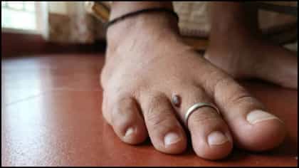 ಕಾಲ್ಬೆರಳುಗಳ ಮೇಲೆ ಮಚ್ಚೆ ಇದೆಯೇ? ಸಾಮುದ್ರಿಕಶಾಸ್ತ್ರ ಹೇಳುವುದೇನು ಗೊತ್ತಾ?