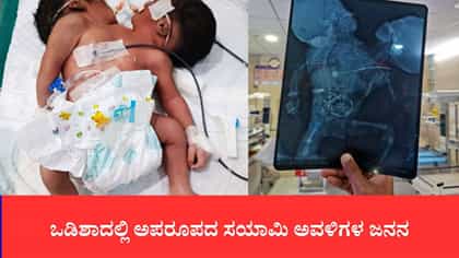 ಒಡಿಶಾದಲ್ಲಿ ಅಪರೂಪದ ಸಯಾಮಿ ಅವಳಿಗಳ ಜನನ
