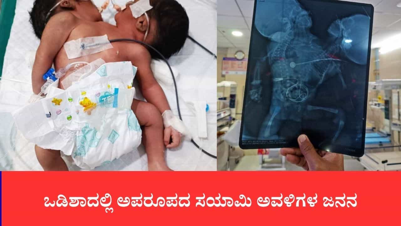 2 ತಲೆ, 2 ಬೆನ್ನುಹುರಿ, ಒಂದೇ ಹೃದಯ: ಒಡಿಶಾದಲ್ಲಿ ಅಪರೂಪದ ಸಯಾಮಿ ಅವಳಿಗಳ ಜನನ, ವೈದ್ಯಕೀಯ ಲೋಕ ದಿಗ್ಭ್ರಮೆ